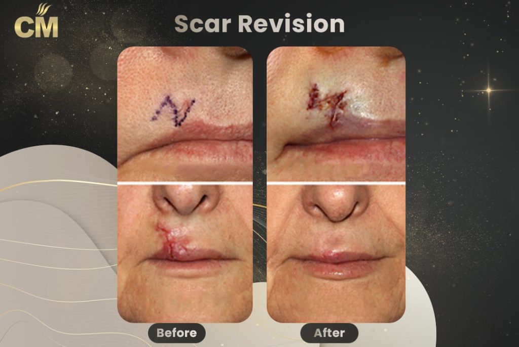 Z plasty Scar Revision Before After