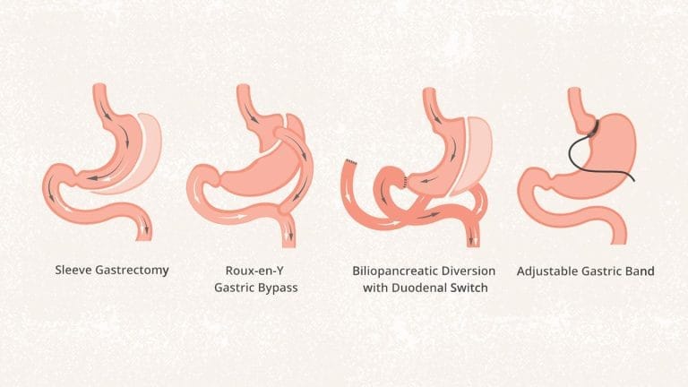 Obesity - Gastric Sleeve Surgery