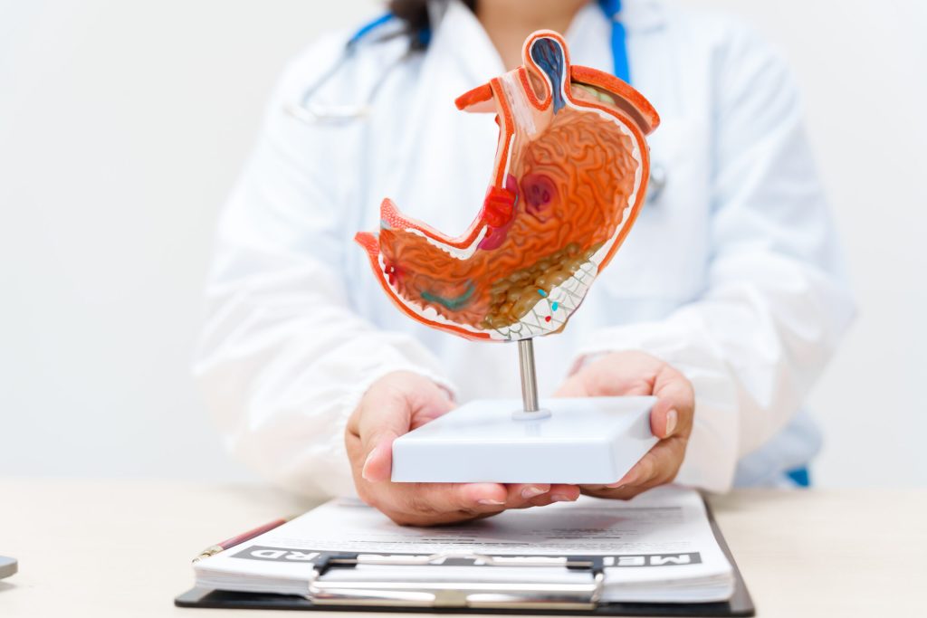 Diet After Sleeve Gastrectomy