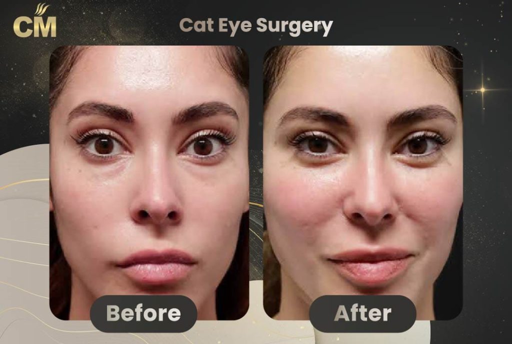 Cat Eye Surgery Before After