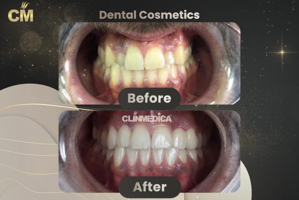 Dental Crowns Before and After in Turkey