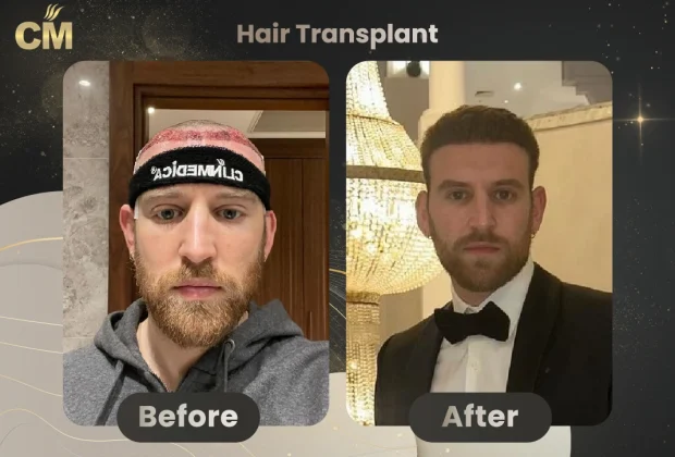DHI hair transplant