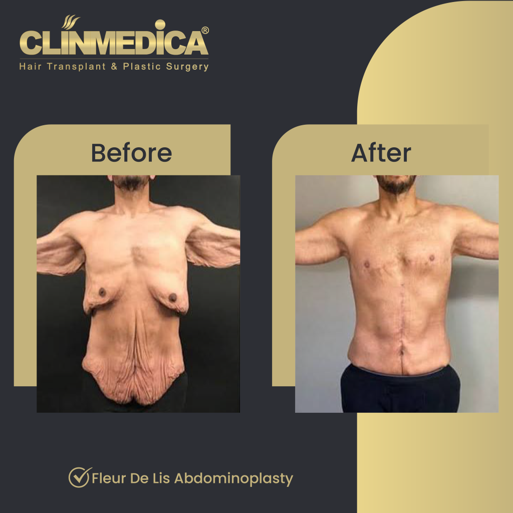 Fleur de lis abdominoplasty Before After in Turkey