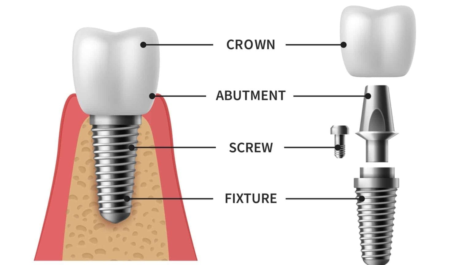 Dental Implants Procedure