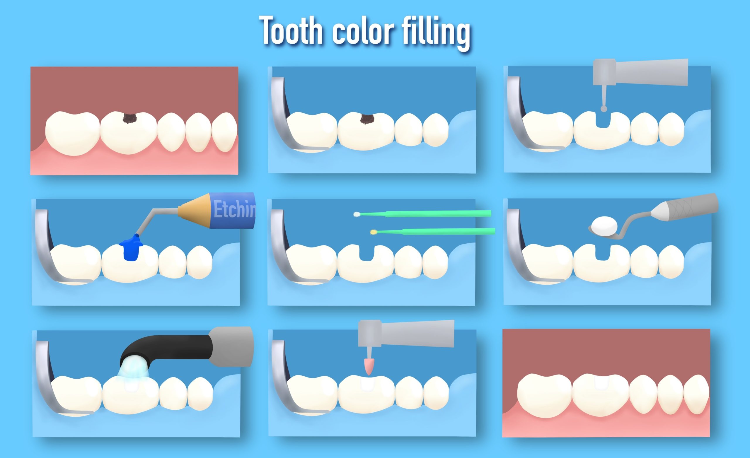 The Composite Filling Procedure – Step-by-Step Guide