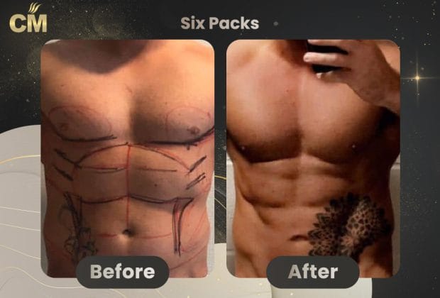 Six Packs Before and After in Turkey