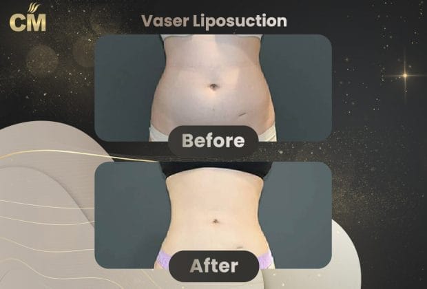 Vaser Liposuction Before and After-2