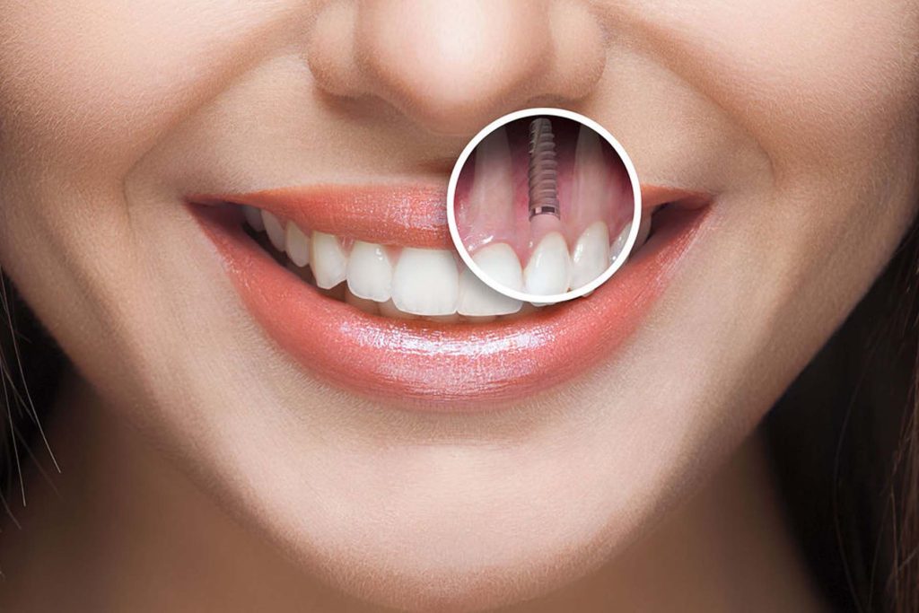 Dental And Teeth Implants In Turkey